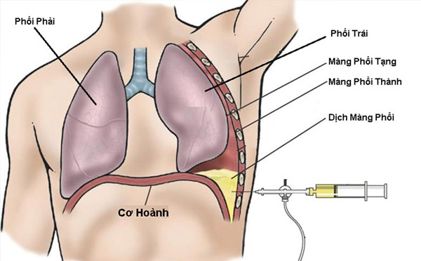 Chọc hút dịch màng phổi để điều trị cho người bị tràn dịch màng phổi